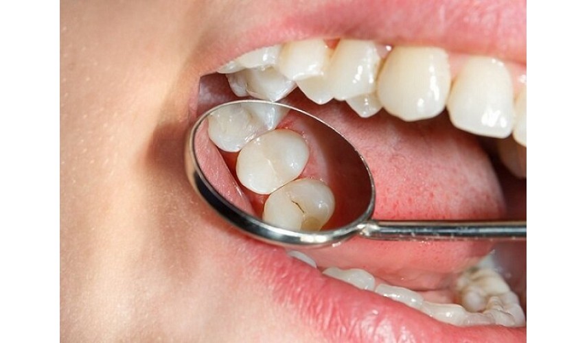 How to remove cavities without fluoride